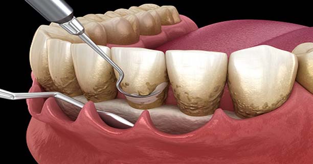 Gingival Curettage
